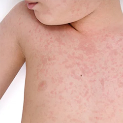 Penicillin Allergy Assessment Interviews: ‘Big Bang for Your Buck’