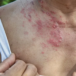 Shingles Vaccine Reaction Hives