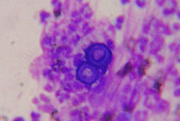 Genomic Sequencing Blastomycosis Infections Blastomycosis Blastomyces ...